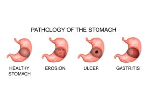 Pathology of the stomach